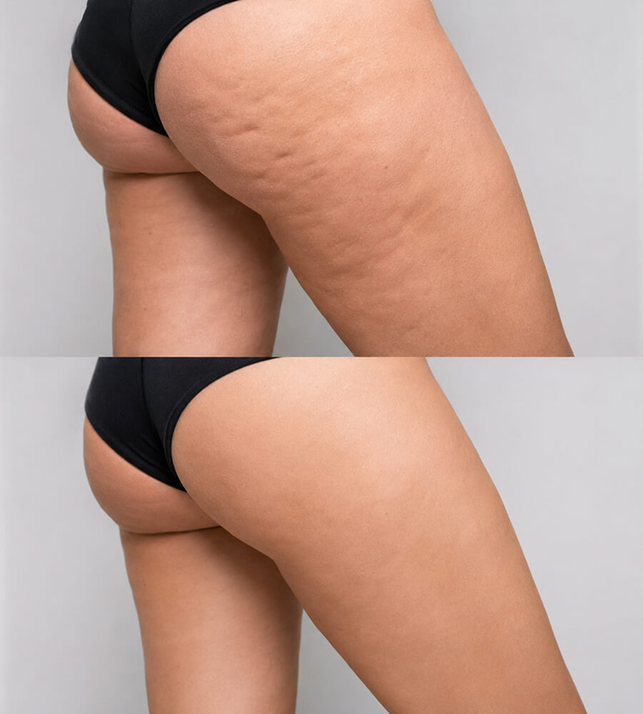 Результат до и после: VelaShape массаж